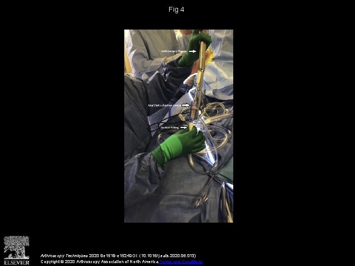 Fig 4 Arthroscopy Techniques 2020 9 e 1519 -e 1524 DOI: (10. 1016/j. eats.