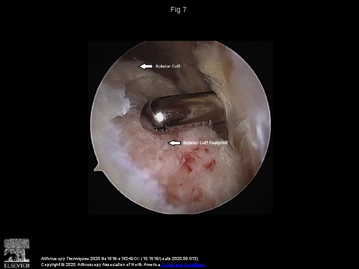 Fig 7 Arthroscopy Techniques 2020 9 e 1519 -e 1524 DOI: (10. 1016/j. eats.