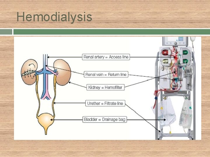 Hemodialysis 