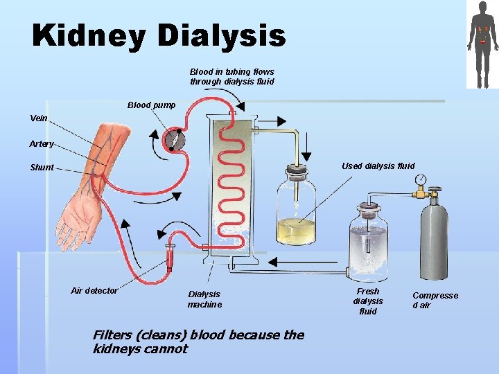 Kidney Dialysis Blood in tubing flows through dialysis fluid Blood pump Vein Artery Used