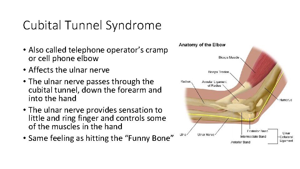 Cubital Tunnel Syndrome • Also called telephone operator’s cramp or cell phone elbow •