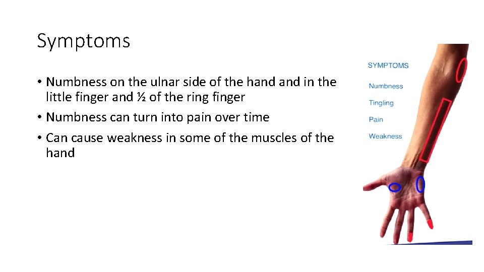 Symptoms • Numbness on the ulnar side of the hand in the little finger