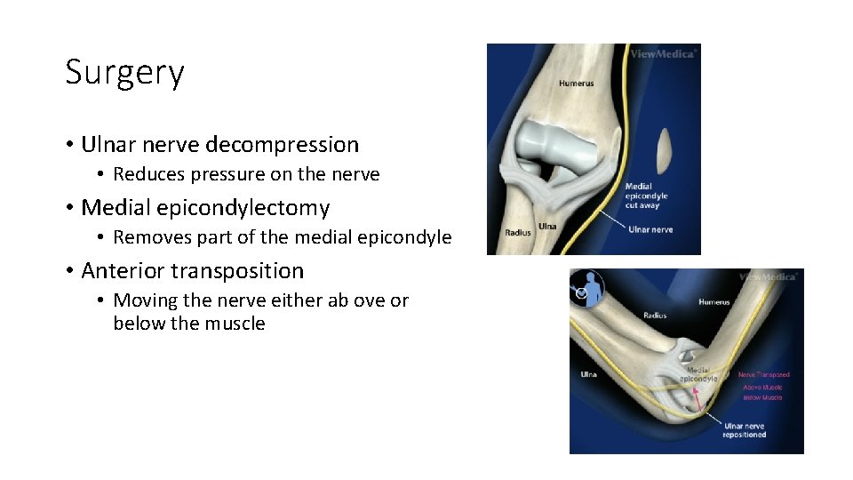 Surgery • Ulnar nerve decompression • Reduces pressure on the nerve • Medial epicondylectomy