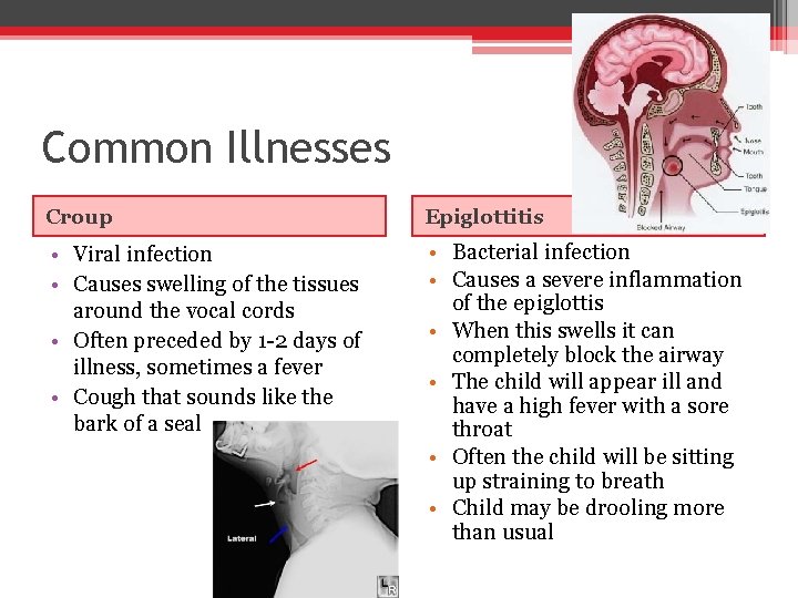 Common Illnesses Croup Epiglottitis • Viral infection • Causes swelling of the tissues around