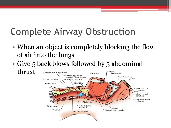 Complete Airway Obstruction • When an object is completely blocking the flow of air