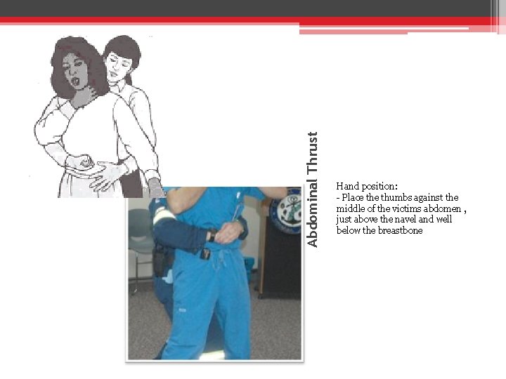 Abdominal Thrust Hand position: - Place thumbs against the middle of the victims abdomen