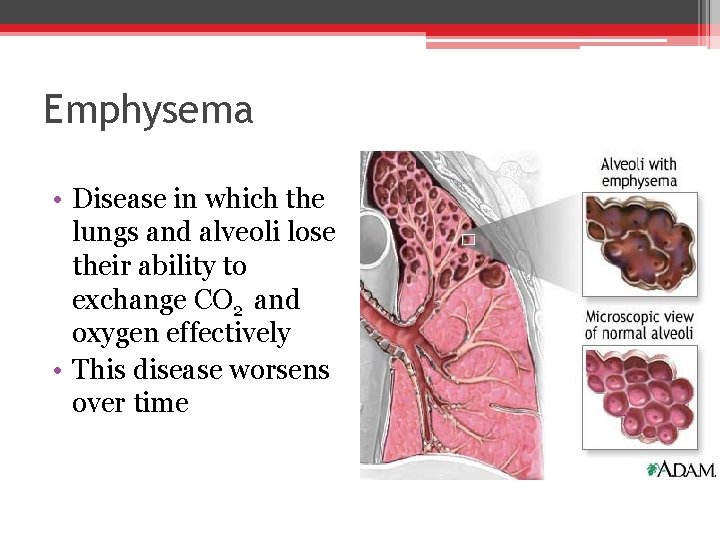 Emphysema • Disease in which the lungs and alveoli lose their ability to exchange