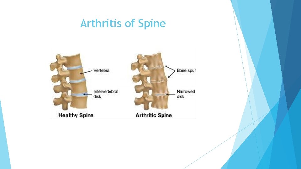 Arthritis of Spine 