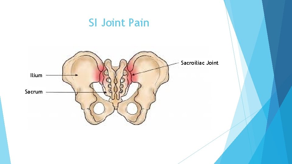 SI Joint Pain Sacroiliac Joint Ilium Sacrum 