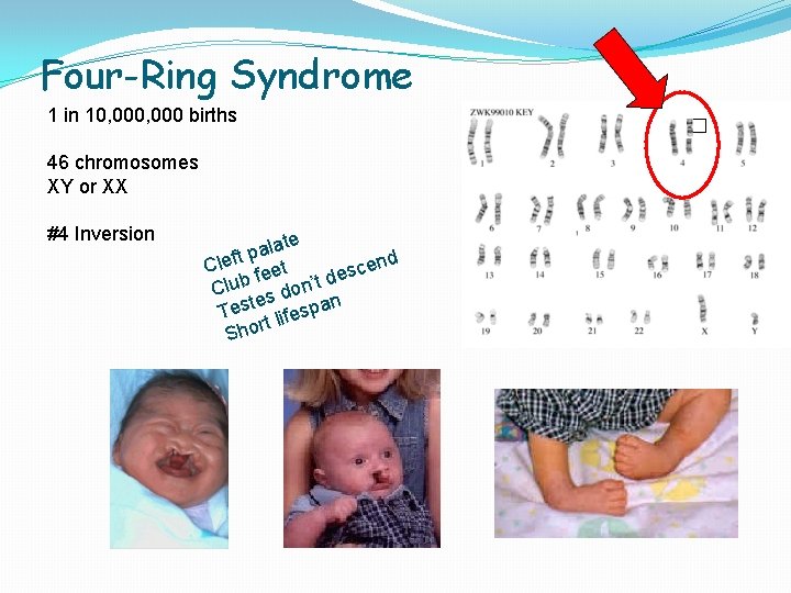 Four-Ring Syndrome 1 in 10, 000 births 46 chromosomes XY or XX #4 Inversion
