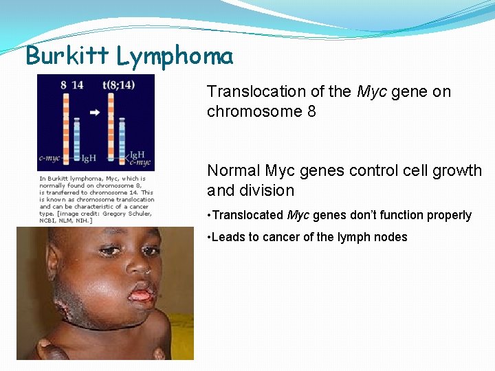 Burkitt Lymphoma Translocation of the Myc gene on chromosome 8 Normal Myc genes control