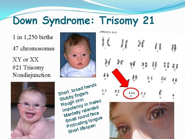 Down Syndrome: Trisomy 21 1 in 1, 250 births 47 chromosomes XY or XX