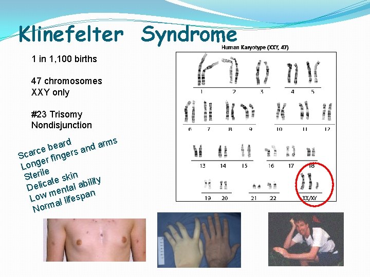 Klinefelter Syndrome 1 in 1, 100 births 47 chromosomes XXY only #23 Trisomy Nondisjunction