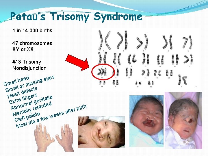Patau’s Trisomy Syndrome 1 in 14, 000 births 47 chromosomes XY or XX #13