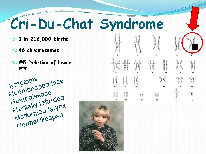 Cri-Du-Chat Syndrome 1 in 216, 000 births 46 chromosomes #5 Deletion of lower arm