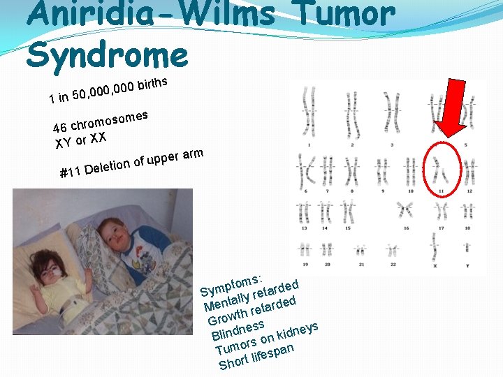 Aniridia-Wilms Tumor Syndrome ths 1 0 bir 0 0 , 0 0 0 in