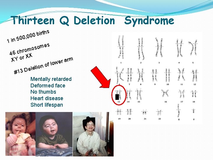 Thirteen Q Deletion Syndrome 1 in irths b 0 0 500, 0 mes o