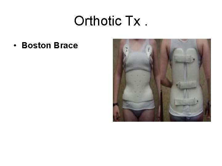 Orthotic Tx. • Boston Brace 