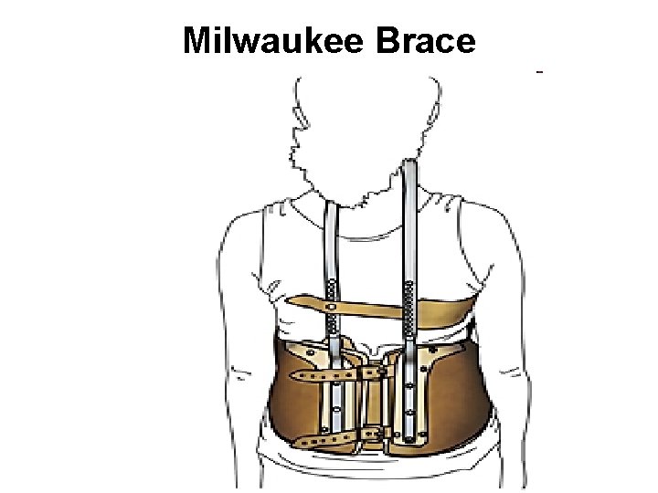 Milwaukee Brace 