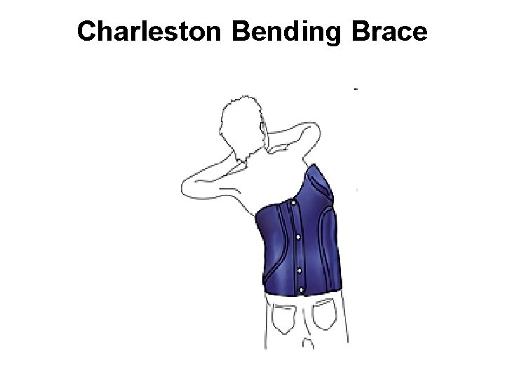 Charleston Bending Brace 