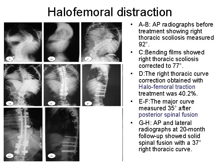 Halofemoral distraction • A-B: AP radiographs before treatment showing right thoracic scoliosis measured 92°.