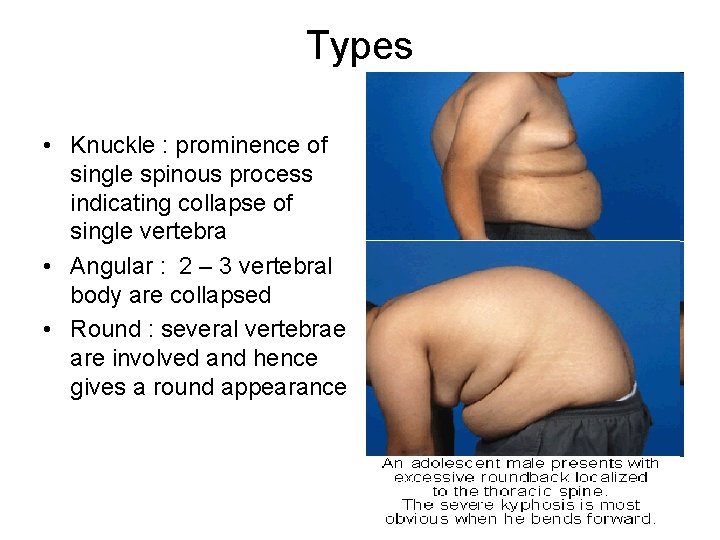 Types • Knuckle : prominence of single spinous process indicating collapse of single vertebra