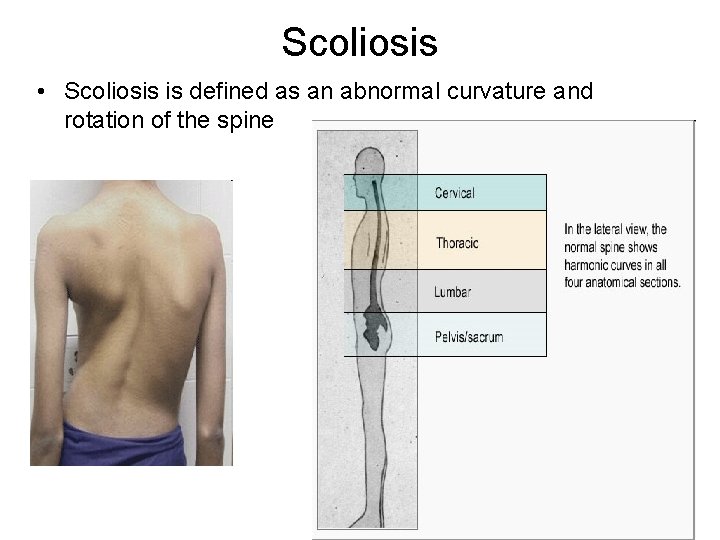 Scoliosis • Scoliosis is defined as an abnormal curvature and rotation of the spine