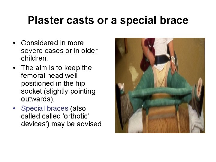 Plaster casts or a special brace • Considered in more severe cases or in