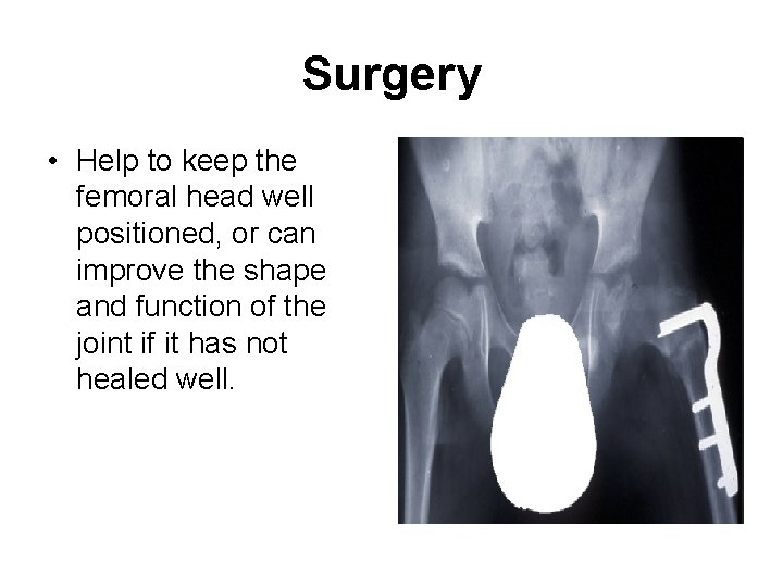 Surgery • Help to keep the femoral head well positioned, or can improve the
