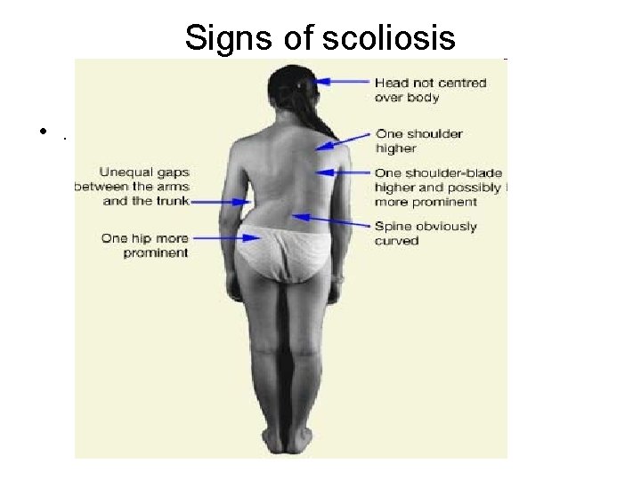 Signs of scoliosis • . 