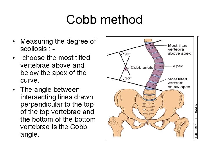 Cobb method • Measuring the degree of scoliosis : • choose the most tilted