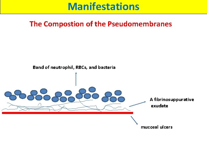 Manifestations The Compostion of the Pseudomembranes Band of neutrophil, RBCs, and bacteria A fibrinosuppurative