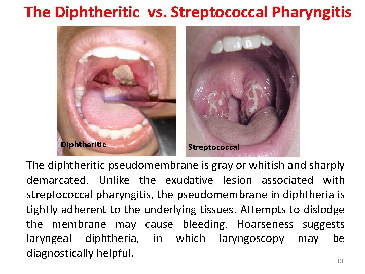 The Diphtheritic vs. Streptococcal Pharyngitis Diphtheritic Streptococcal The diphtheritic pseudomembrane is gray or whitish