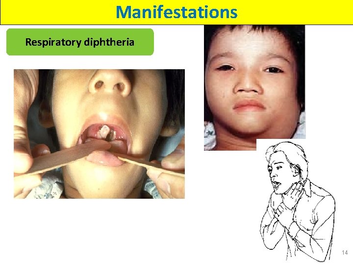 Manifestations Respiratory diphtheria 14 