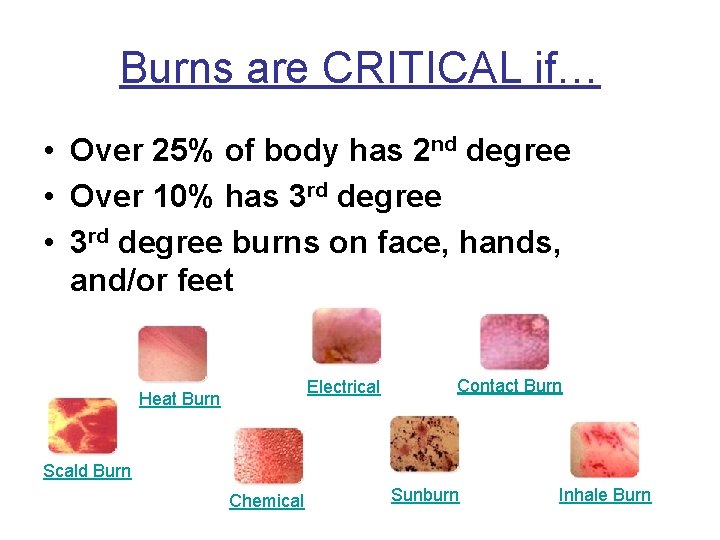 Burns are CRITICAL if… • Over 25% of body has 2 nd degree •