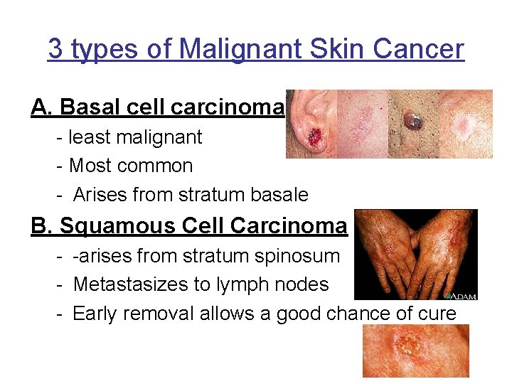 3 types of Malignant Skin Cancer A. Basal cell carcinoma - least malignant -