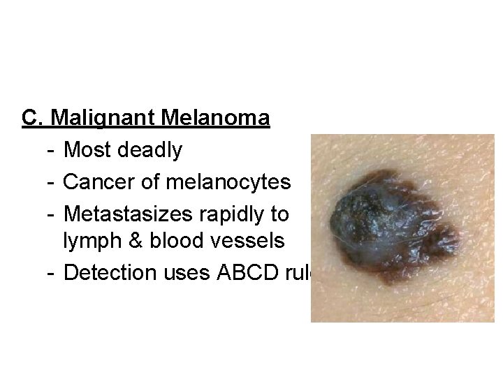 C. Malignant Melanoma - Most deadly - Cancer of melanocytes - Metastasizes rapidly to