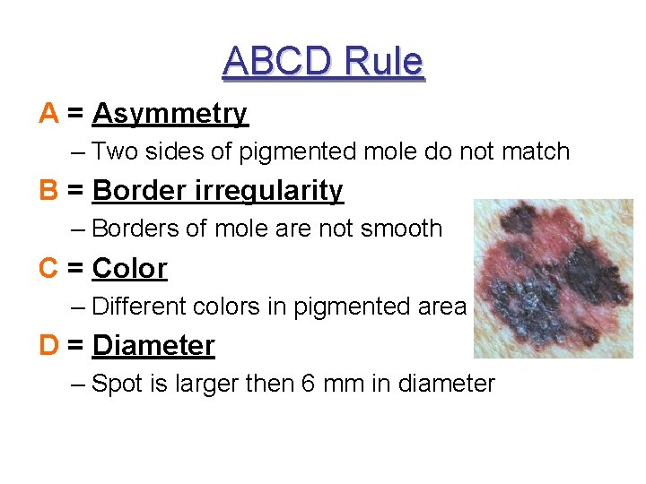 ABCD Rule A = Asymmetry – Two sides of pigmented mole do not match