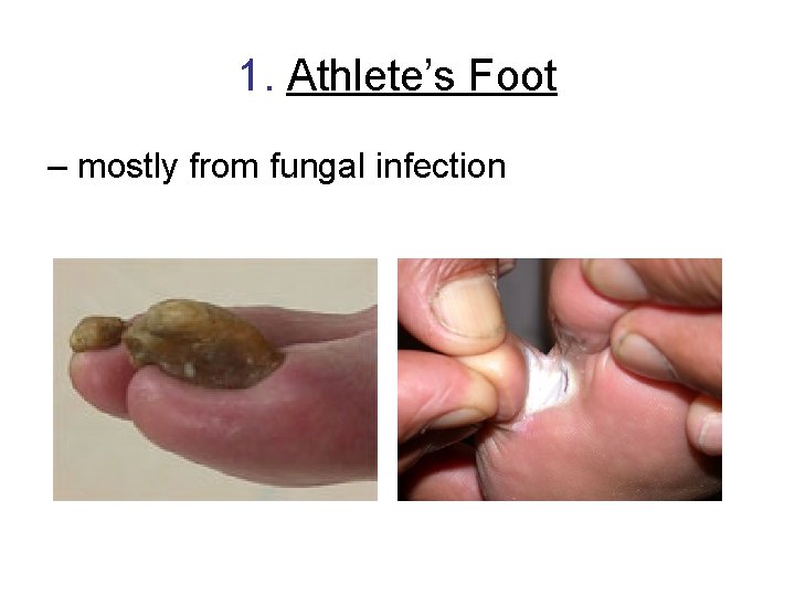 1. Athlete’s Foot – mostly from fungal infection 