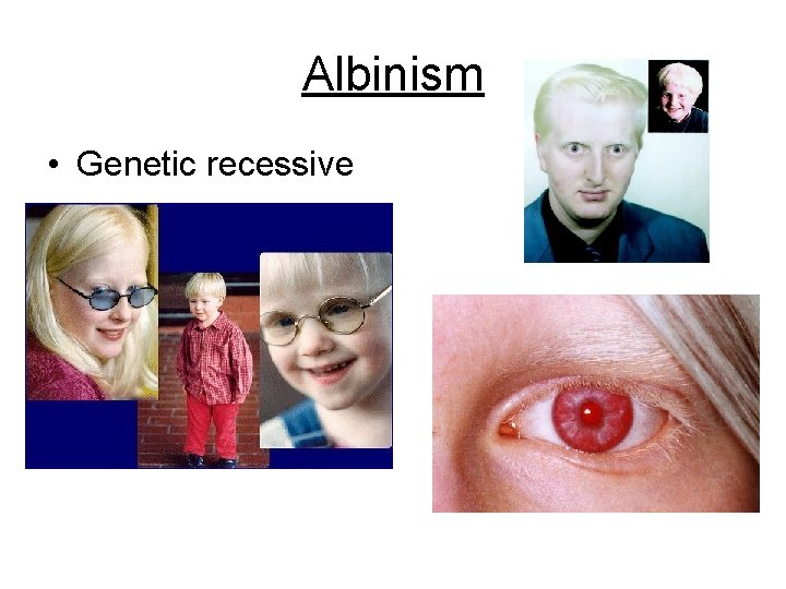 Albinism • Genetic recessive 