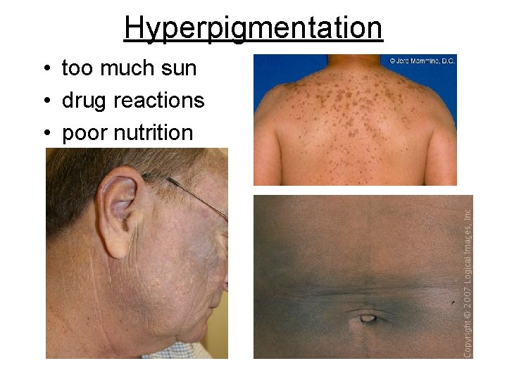 Hyperpigmentation • too much sun • drug reactions • poor nutrition 