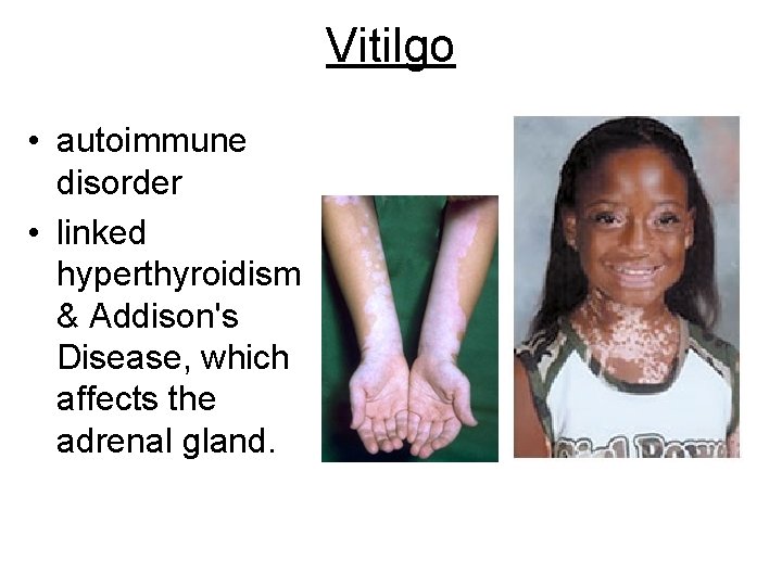 Vitilgo • autoimmune disorder • linked hyperthyroidism & Addison's Disease, which affects the adrenal