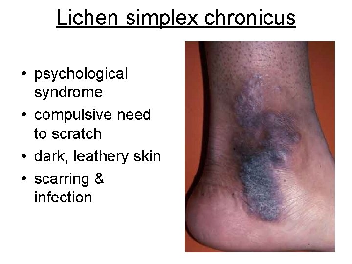 Lichen simplex chronicus • psychological syndrome • compulsive need to scratch • dark, leathery