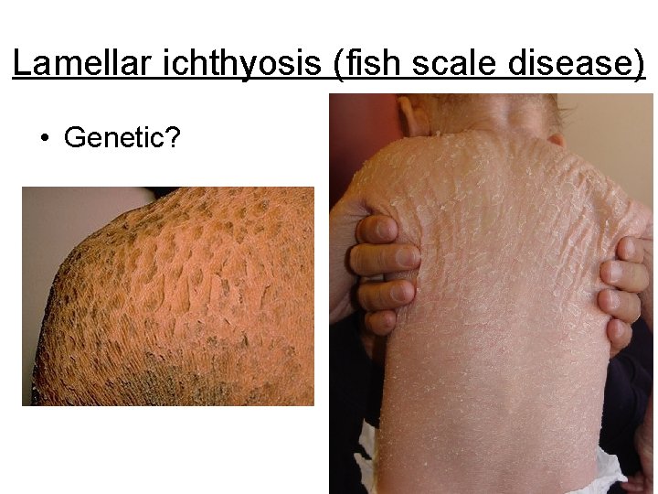 Lamellar ichthyosis (fish scale disease) • Genetic? 