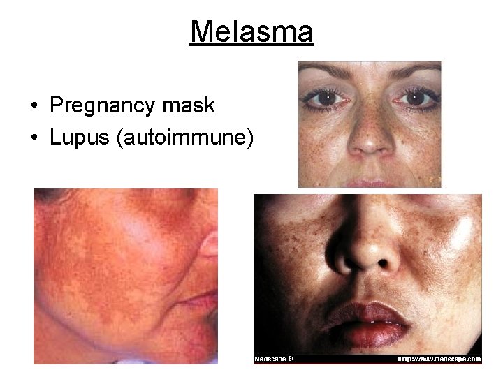 Melasma • Pregnancy mask • Lupus (autoimmune) 