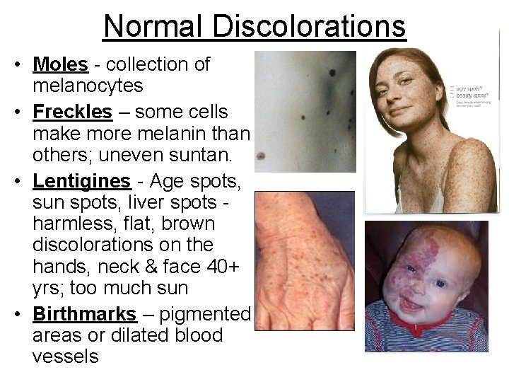Normal Discolorations • Moles - collection of melanocytes • Freckles – some cells make