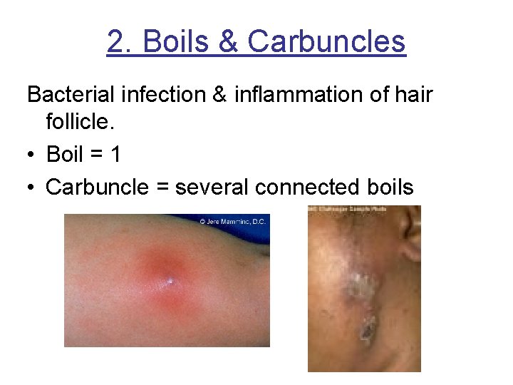 2. Boils & Carbuncles Bacterial infection & inflammation of hair follicle. • Boil =