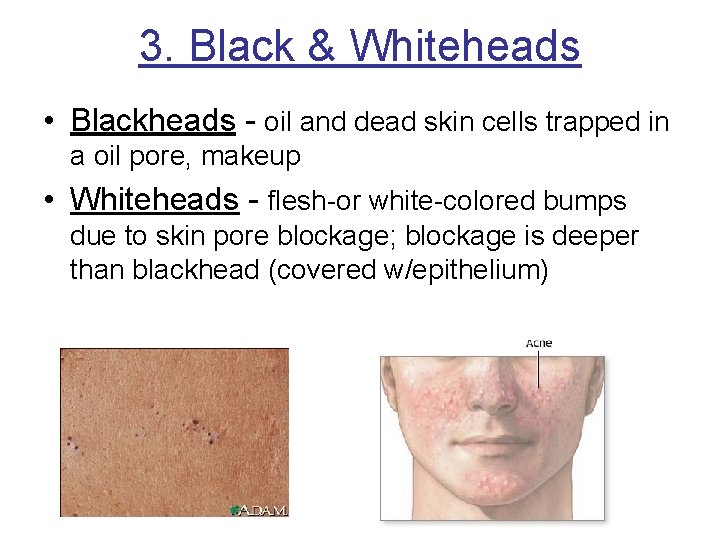 3. Black & Whiteheads • Blackheads - oil and dead skin cells trapped in