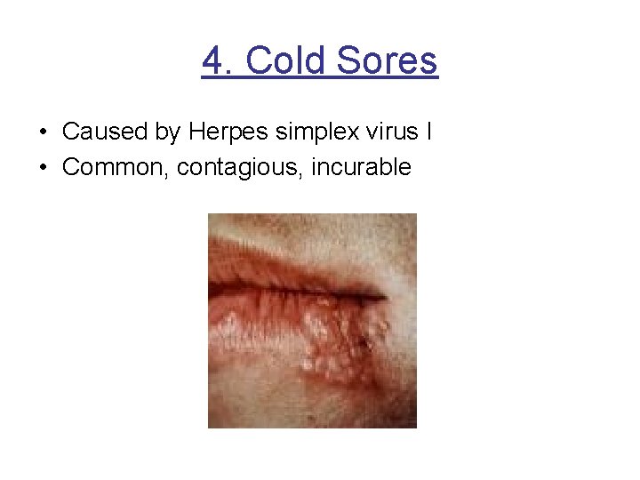 4. Cold Sores • Caused by Herpes simplex virus I • Common, contagious, incurable