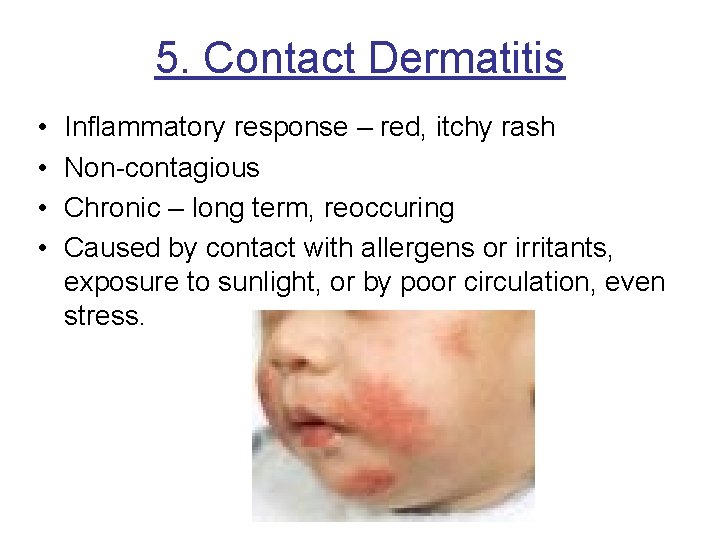 5. Contact Dermatitis • • Inflammatory response – red, itchy rash Non-contagious Chronic –